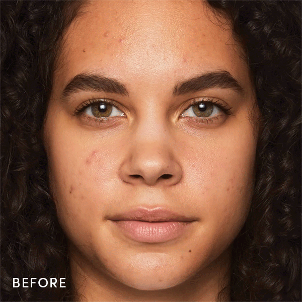 grave rygrad bevæge sig Best Makeup For Acne Prone Skin: Tips & FAQs | jane iredale