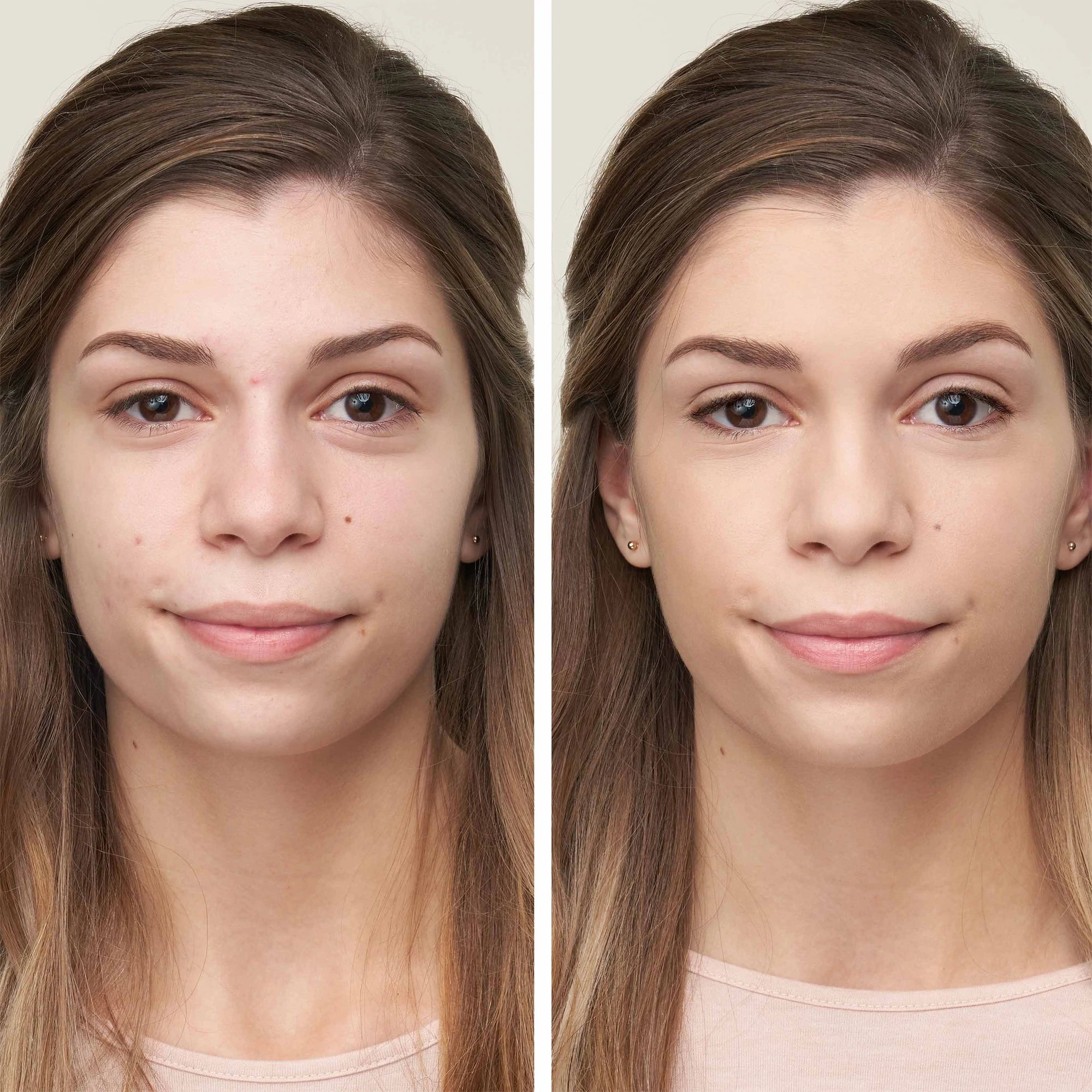 How To Camouflage Acne With Makeup